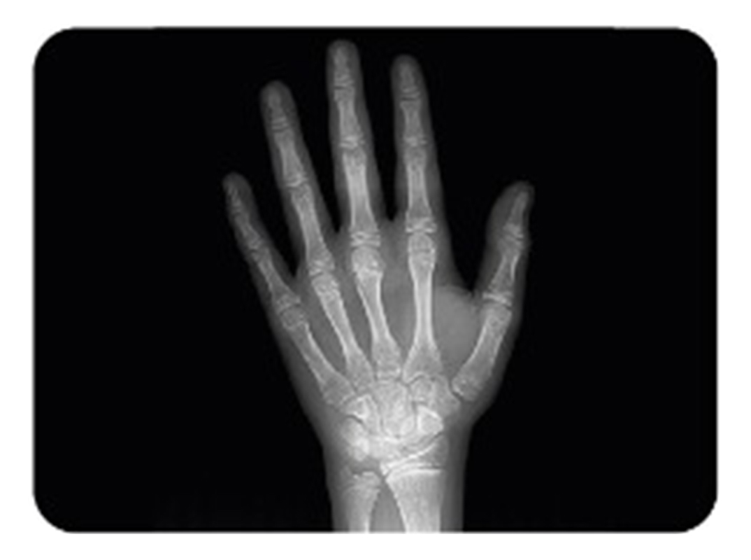 carpal